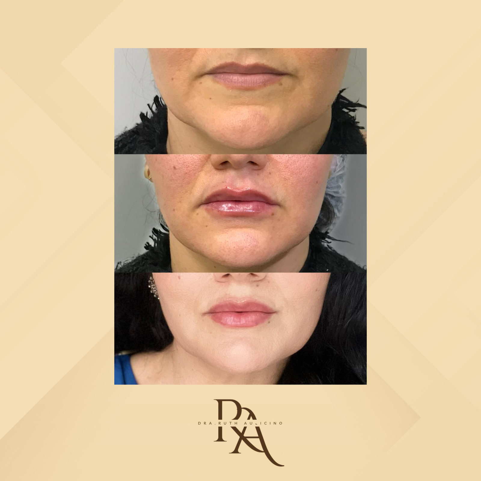 Dra. Ruth Aulicino Preenchimento Labial #1.1