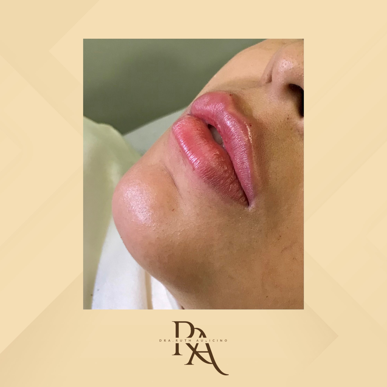 Dra. Ruth Aulicino Preenchimento Labial #2.1