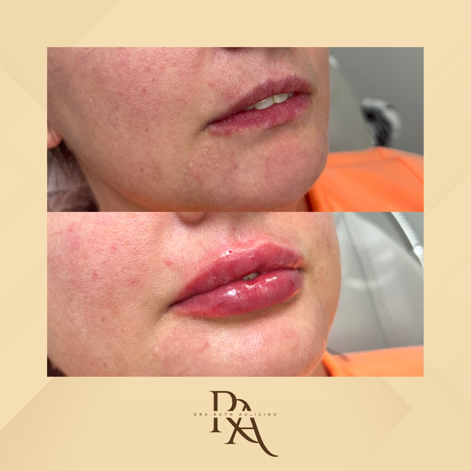 Dra. Ruth Aulicino Preenchimento Labial #3.1