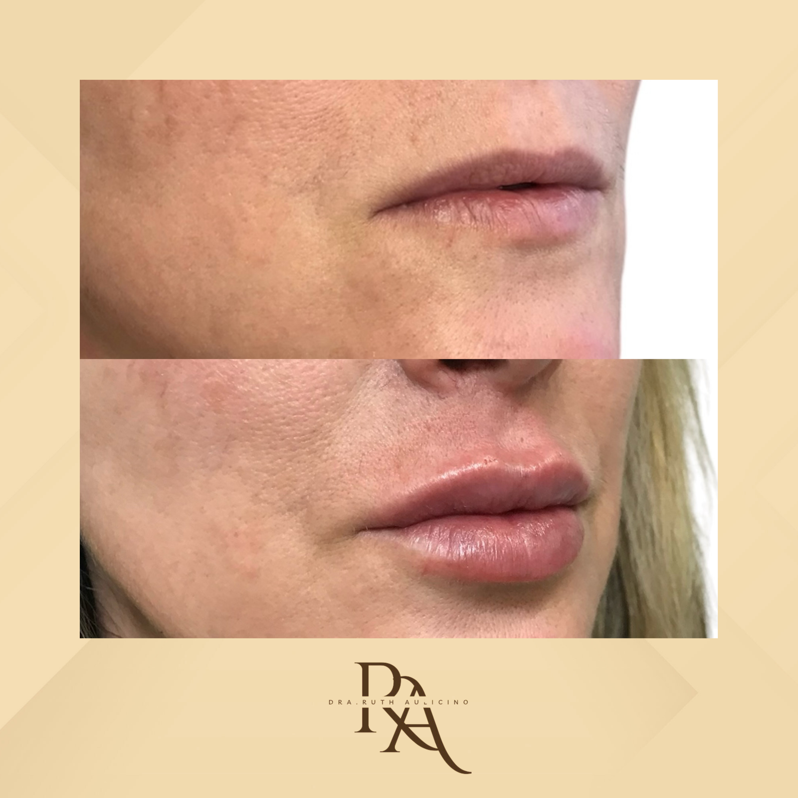 Dra. Ruth Aulicino Preenchimento Labial #4.1