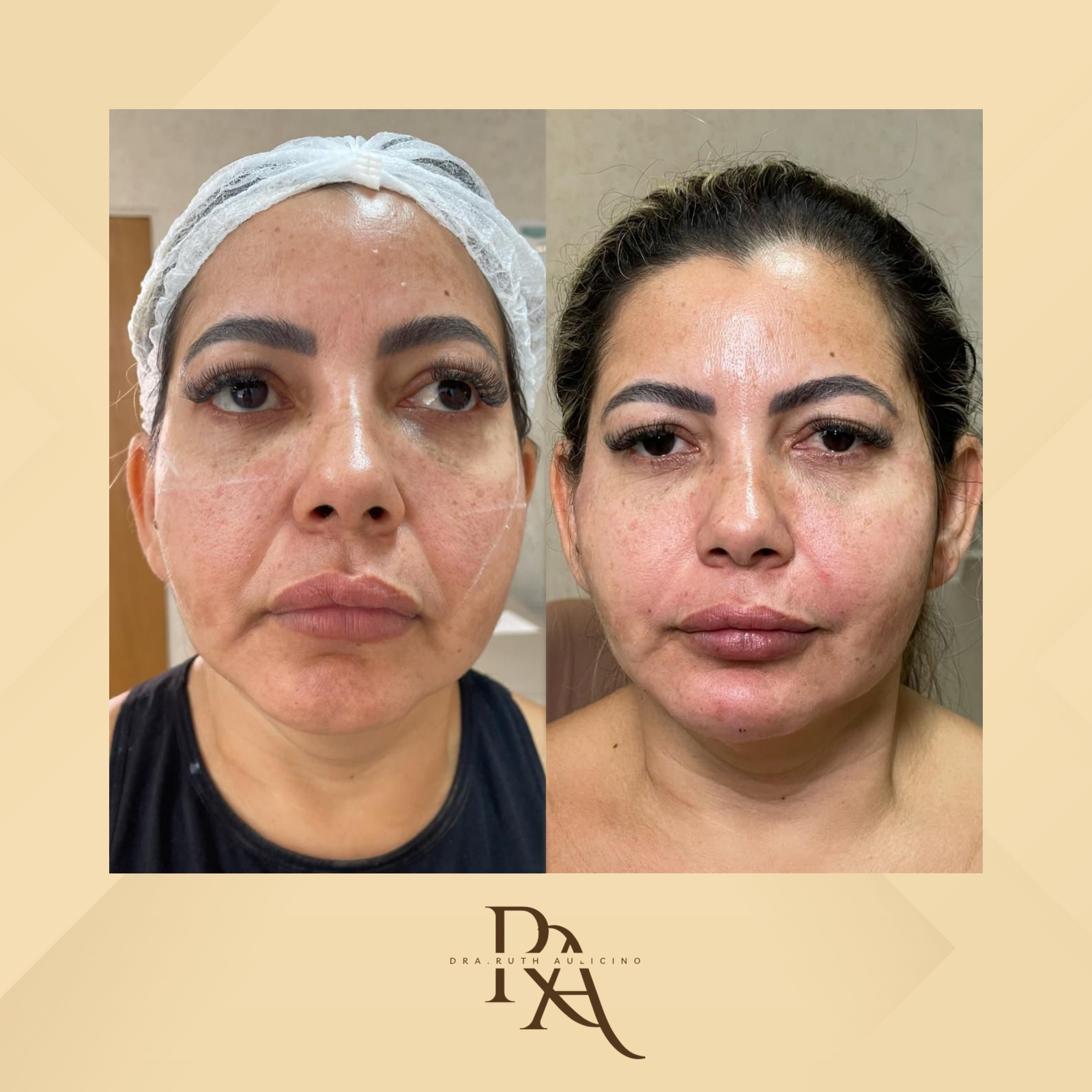 Dra. Ruth Aulicino Rejuvenescimento Facial #1.1
