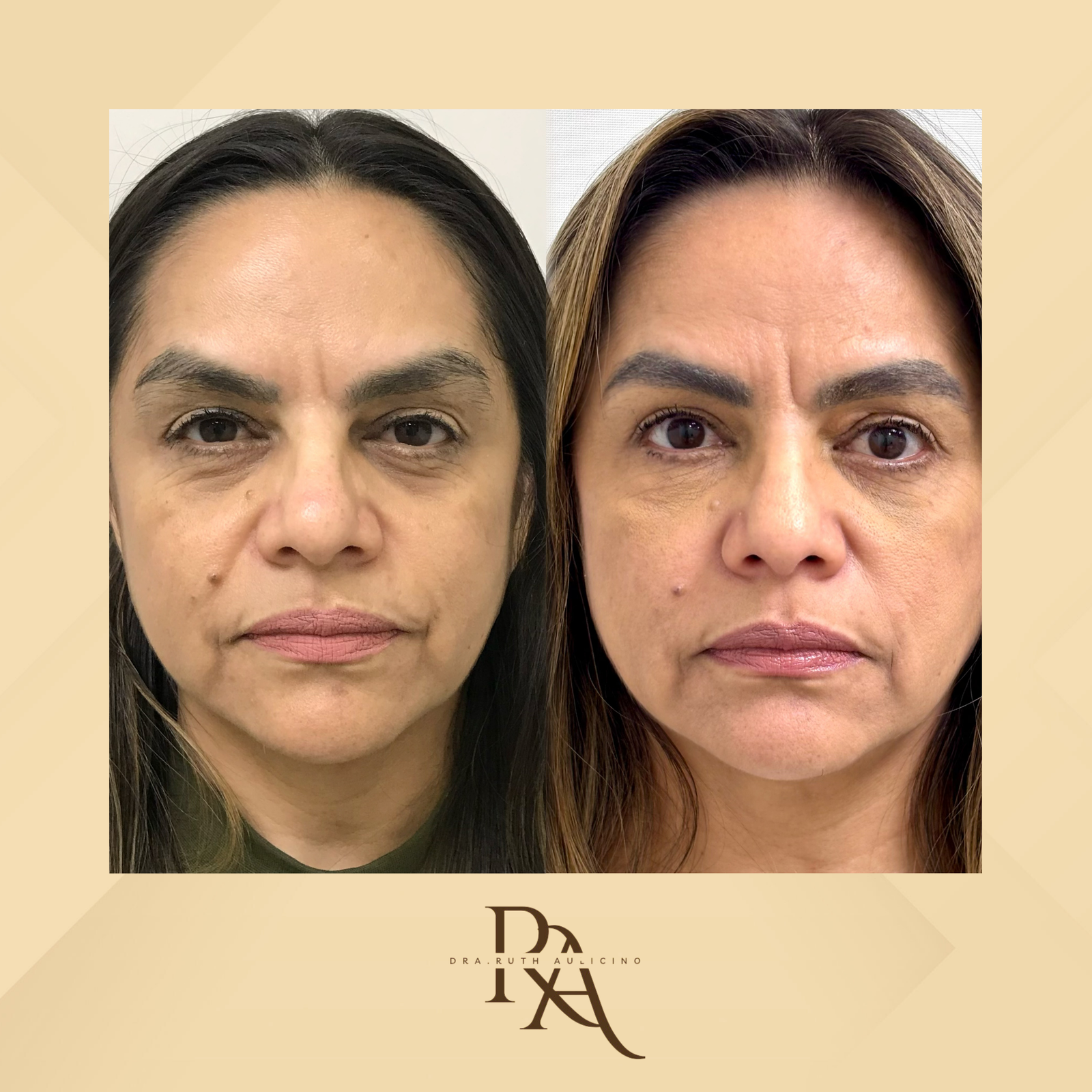 Dra. Ruth Aulicino Rejuvenescimento Facial #2.1