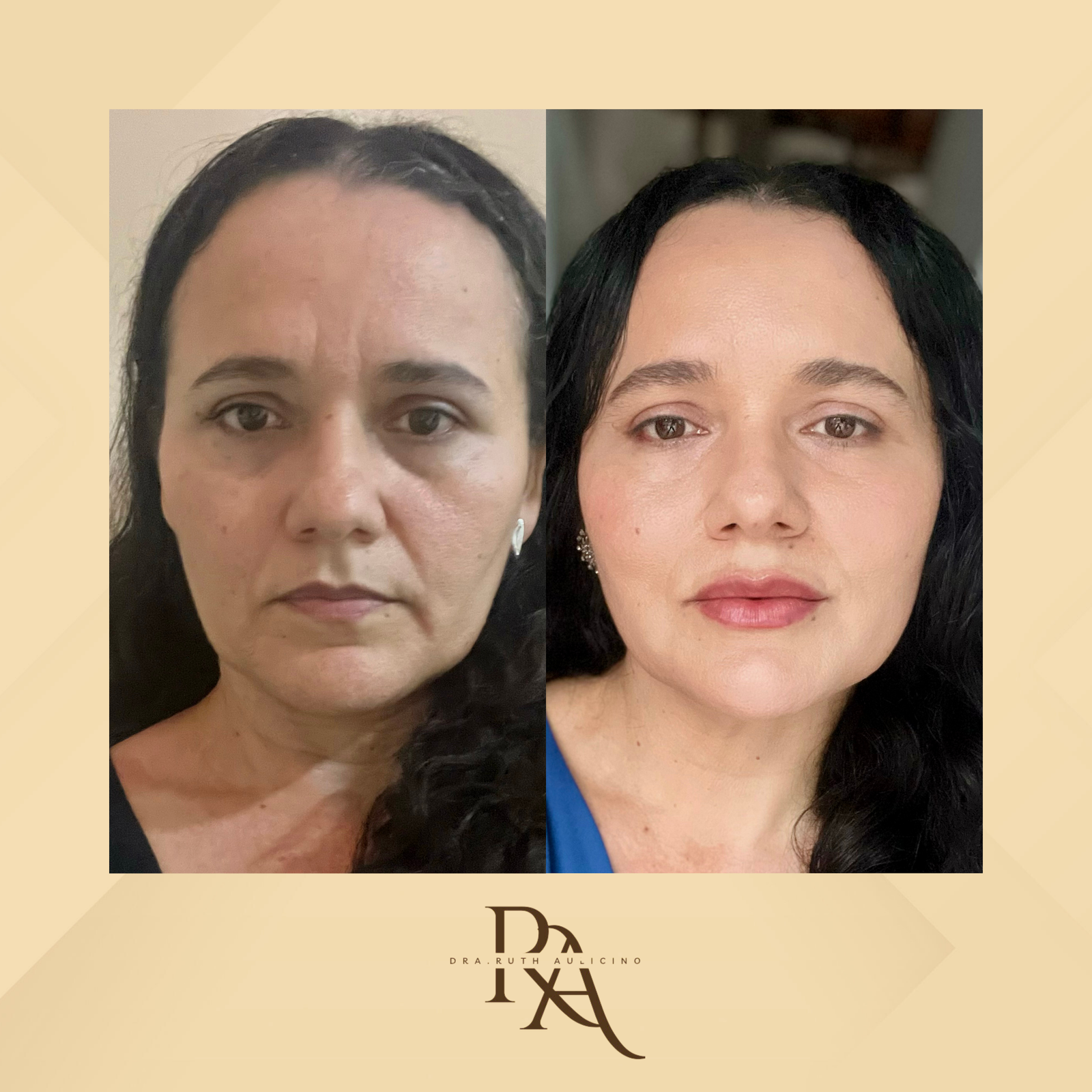 Dra. Ruth Aulicino Rejuvenescimento Facial #3.1