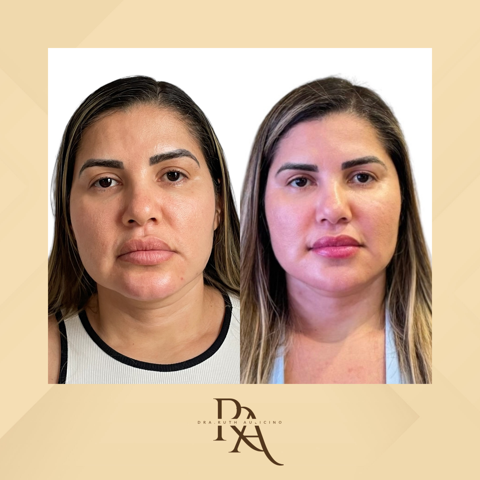 Dra. Ruth Aulicino Rejuvenescimento Facial #4.1