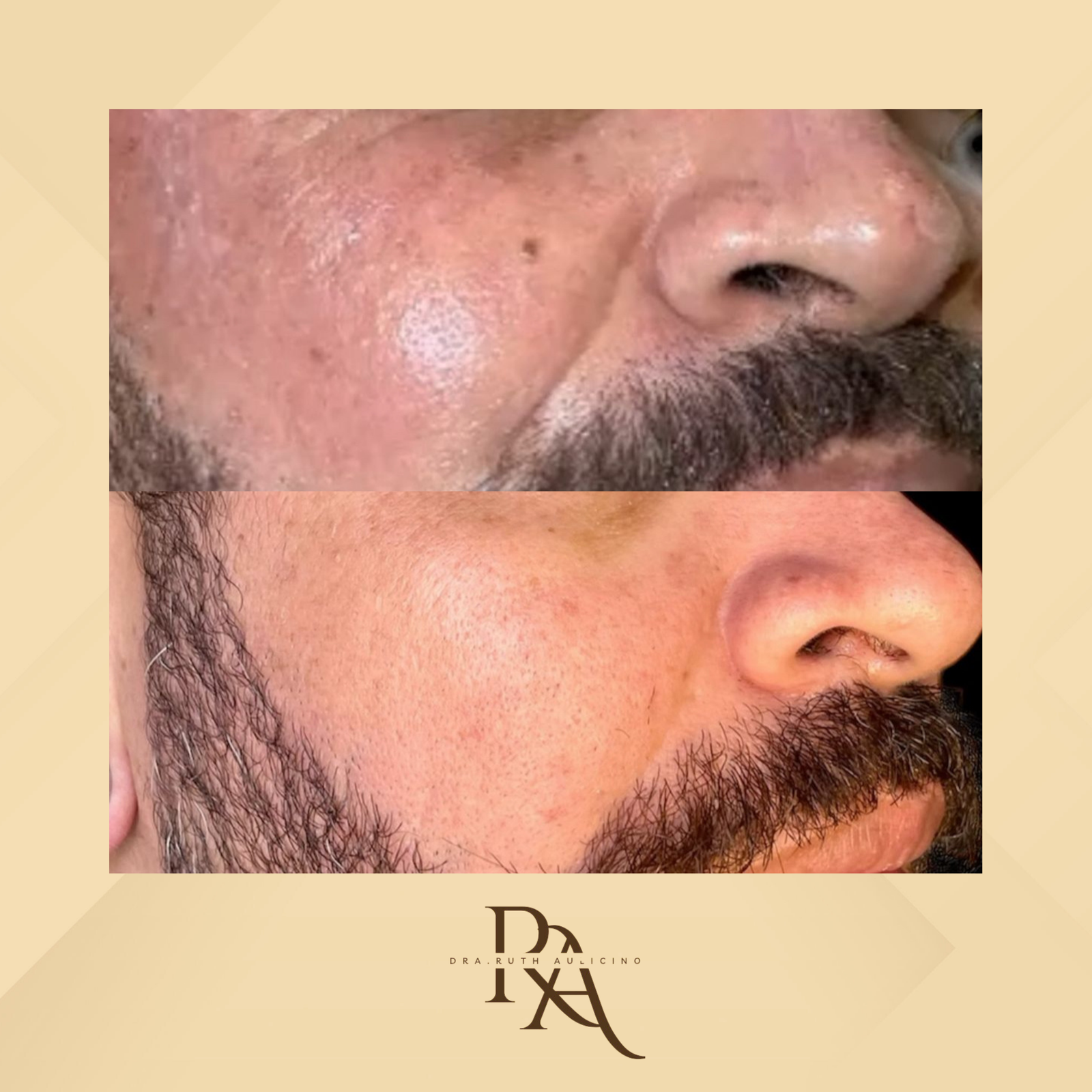 Dra. Ruth Aulicino Toxina Botulínica #3.1
