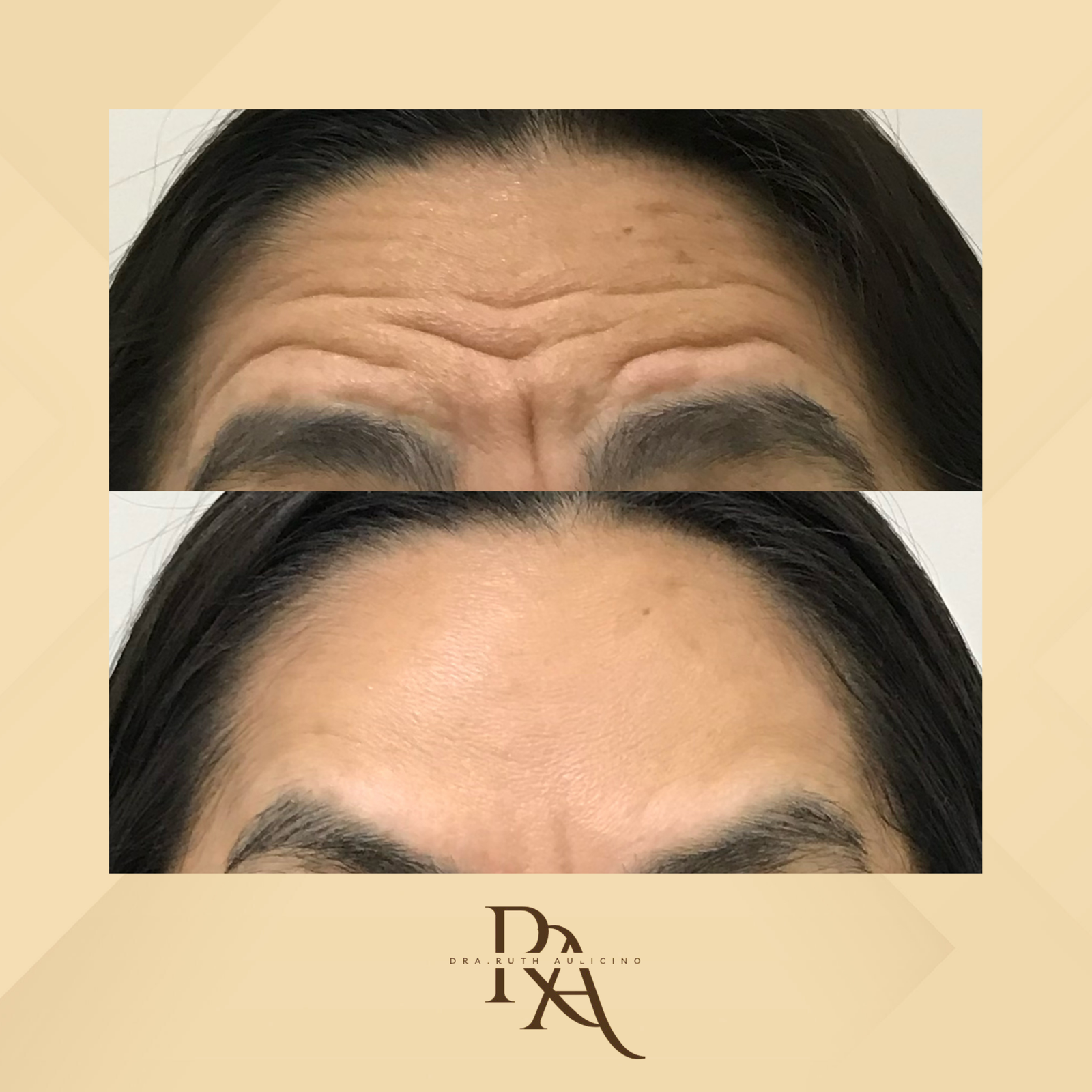 Dra. Ruth Aulicino Toxina Botulínica #4.1