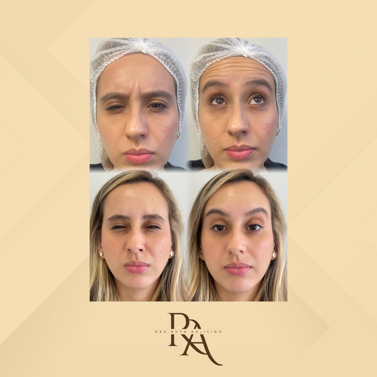 Dra. Ruth Aulicino Toxina Botulínica #6.1